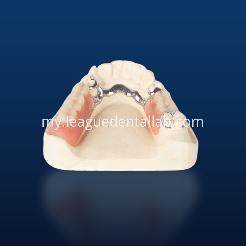 Cast partial,3D printed metal partial,Bego metal partial,cast metal framework,Vatalium Metal framework